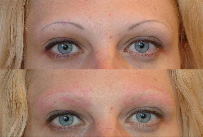 Remoção a laser de sobrancelhas de tatuagem: antes e depois de fotos, resenhas